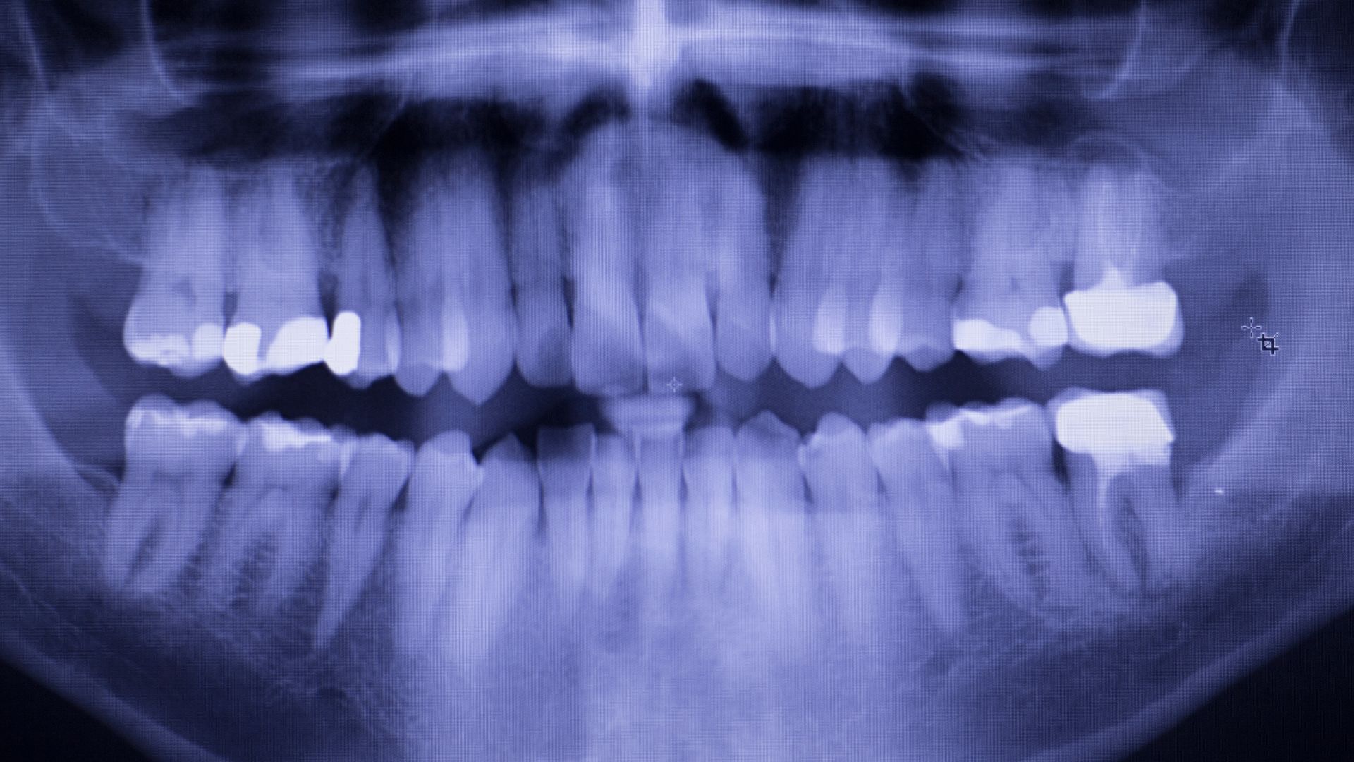 xray of teeth fillings